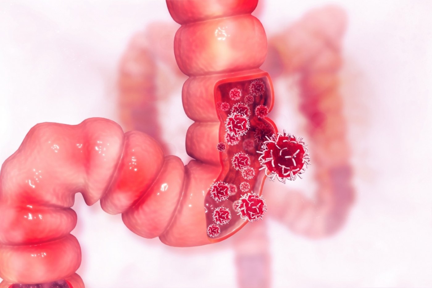 Descoperire în cancerul colorectal, anunțată de australieni