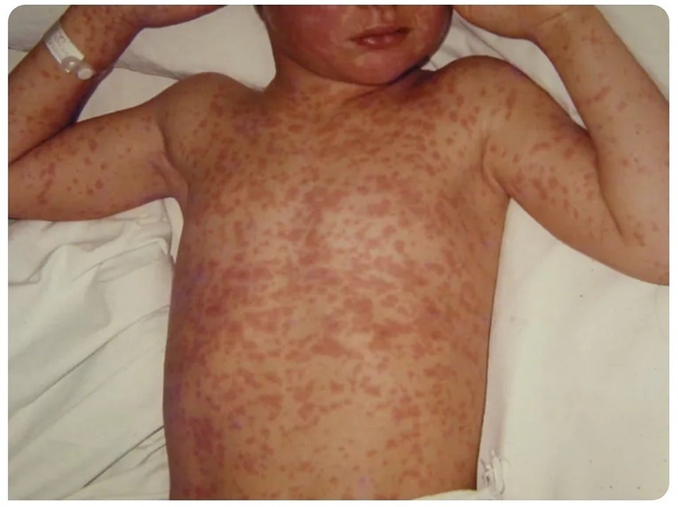 Renumit medic pediatru, avertisment: „Tocmai am văzut un caz sever de rujeolă, boală care, cred unii, nu există”