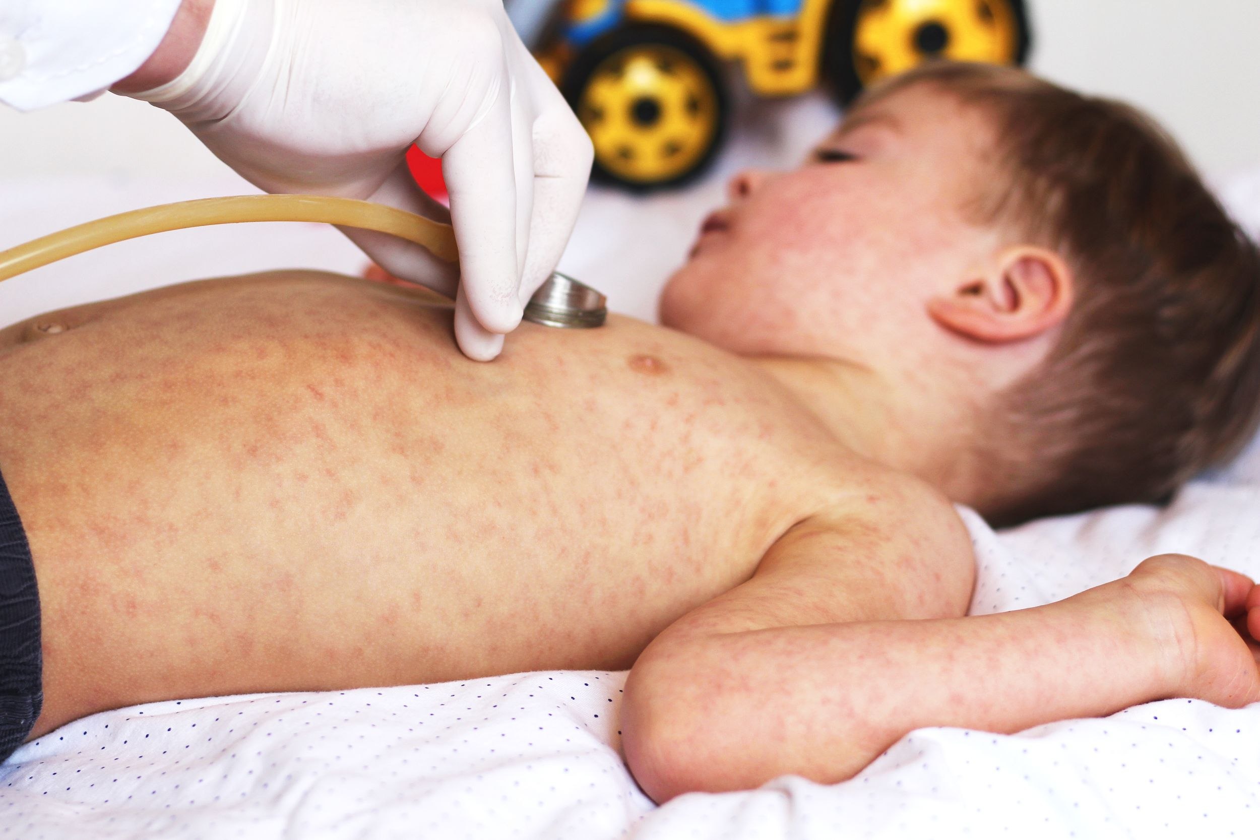 A explodat numărul cazurilor de pojar: „Persoanele neimunizate nu au aproape nicio șansă să scape neinfectate”