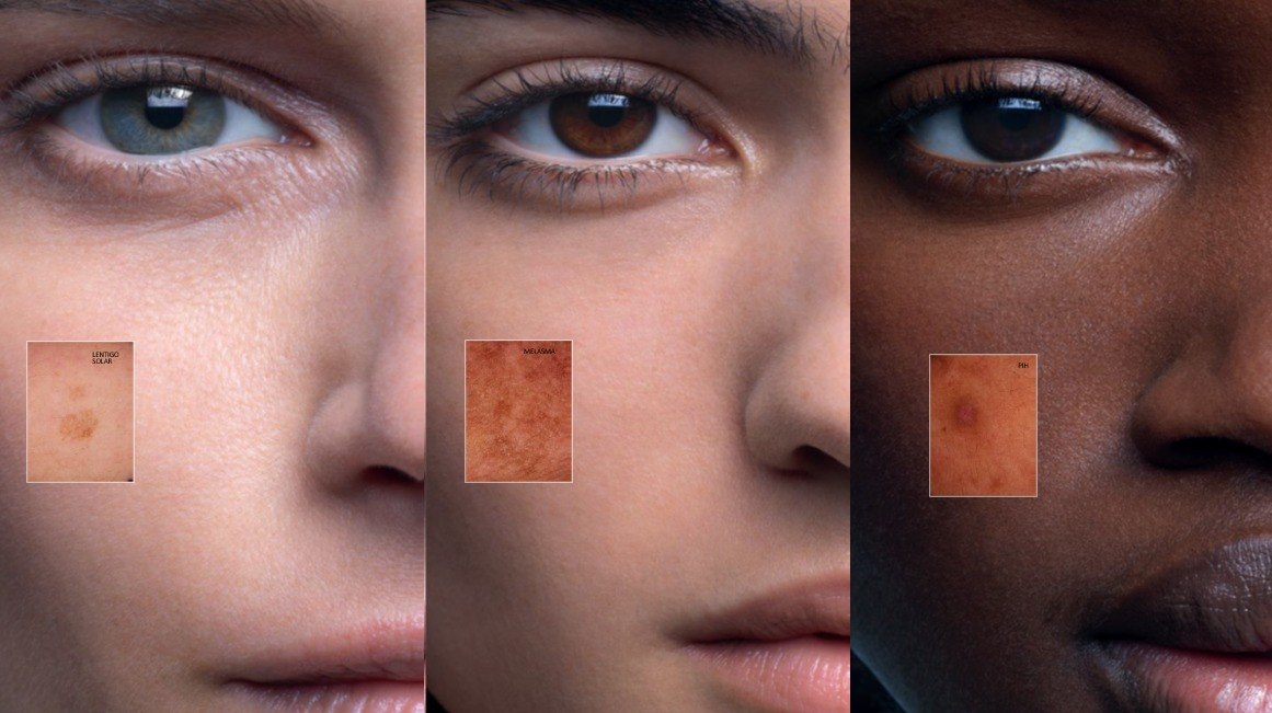 Petele pigmentare – de ce apar, cum le tratăm și cum putem preveni reapariția acestora