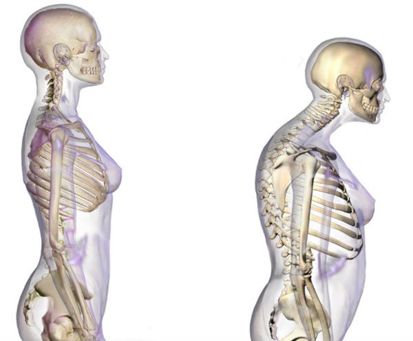 De ce osteoporoza este mai frecventă la femei decât la bărbați. Alimentele ce trebuie introduse în dietă