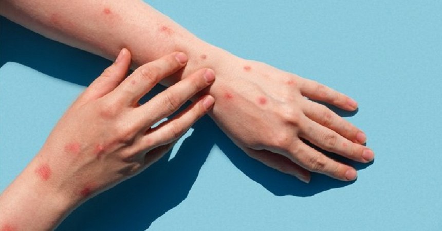 Doctorul Adrian Marinescu, despre variola maimuței: „Am avut cazuri izolate inclusiv în România în anii care au trecut”