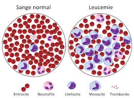 Cum ar putea fi oprită leucemia? Cercetătorii au identificat un posibil mecanism